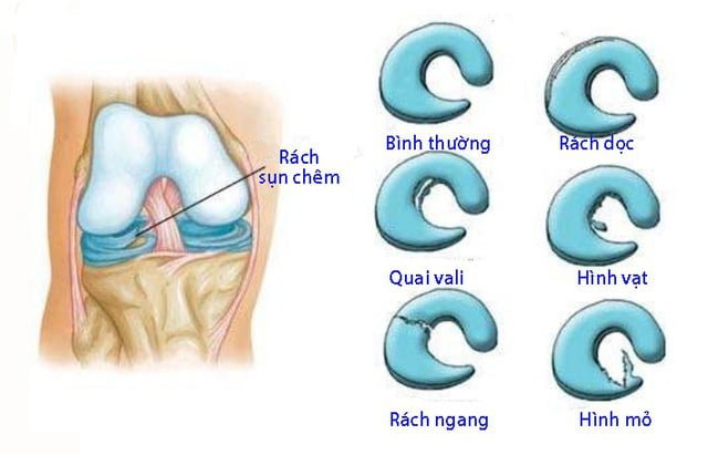 Dấu hiệu của rách sụn chêm